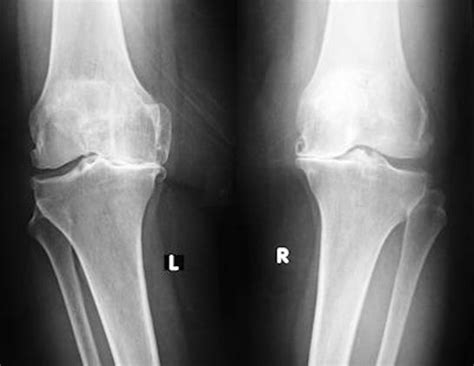 artroz fotoğraflı diz ekleminin röntgen görüntüsü
